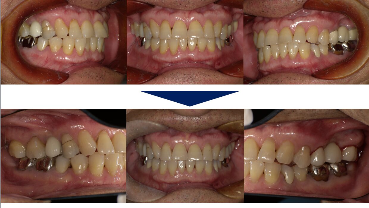 口腔内写真（正面・側面）の比較