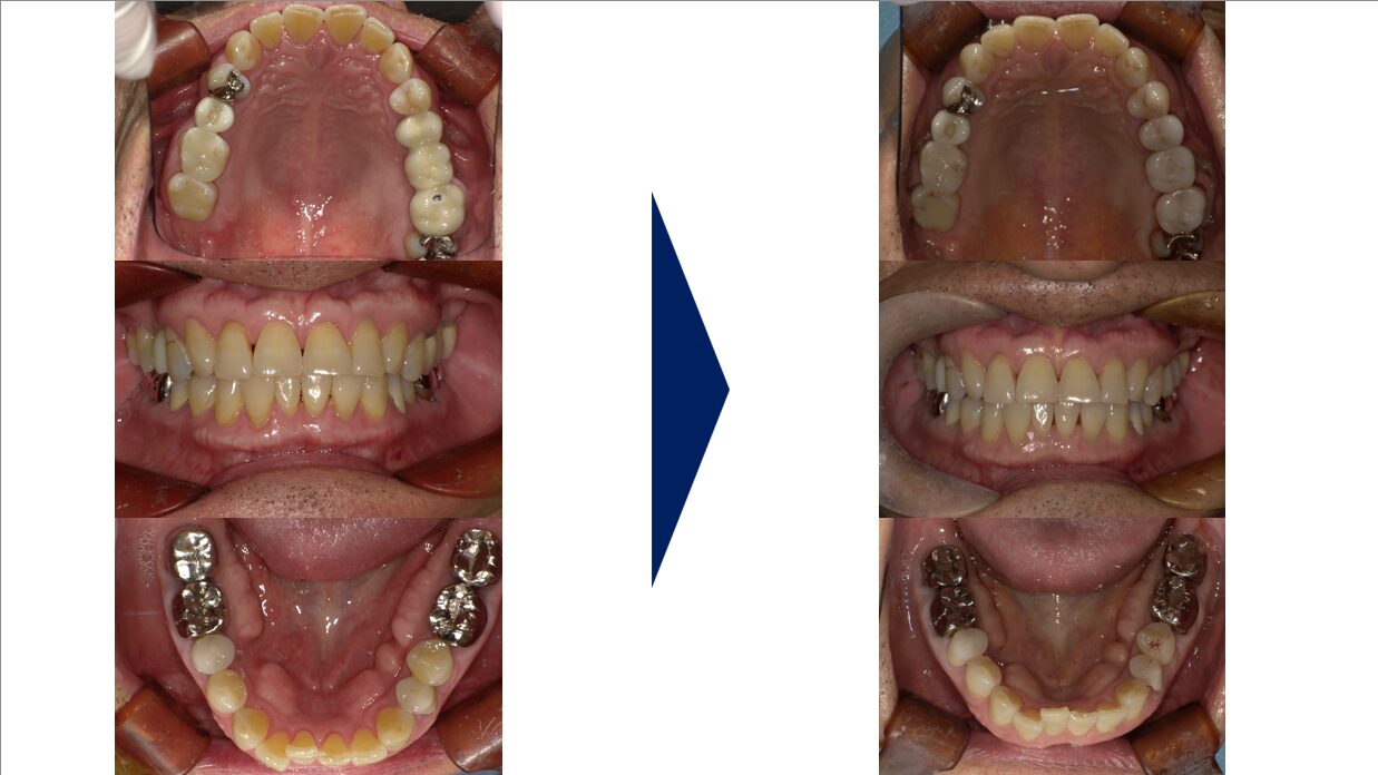 口腔内写真（上下顎面）の比較